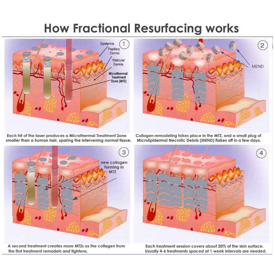 NuBeam Co2 Fractional Resurfacing