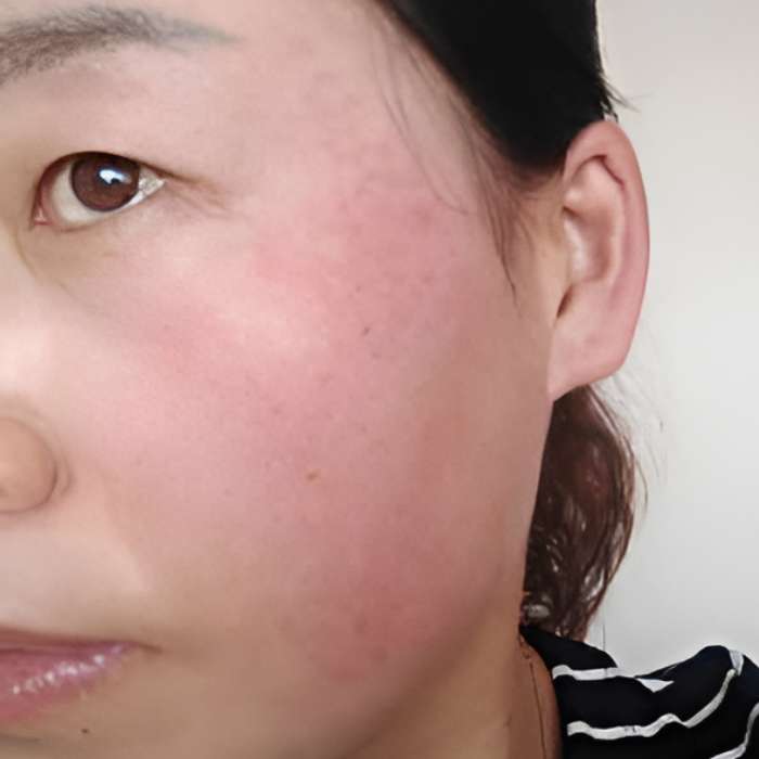 nuGLOW Pico melasma treatment after six sessions — female age 41
