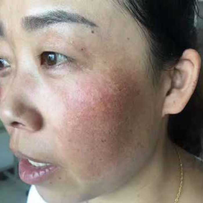 nuGLOW Pico melasma treatment before — female age 41, brown chloasma