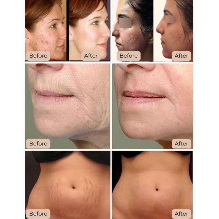 NuSkin MicroNeedling Before and After 11