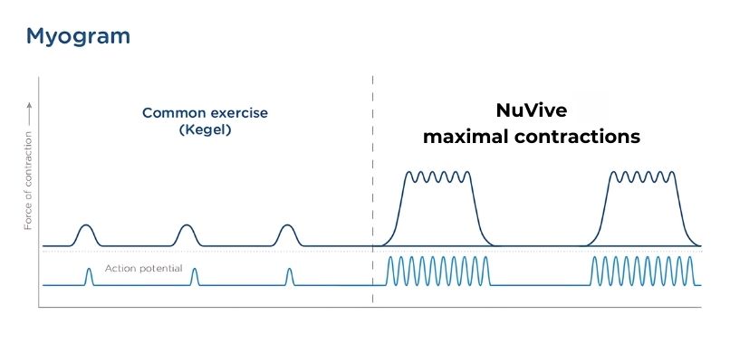 NuVive EM Myogram