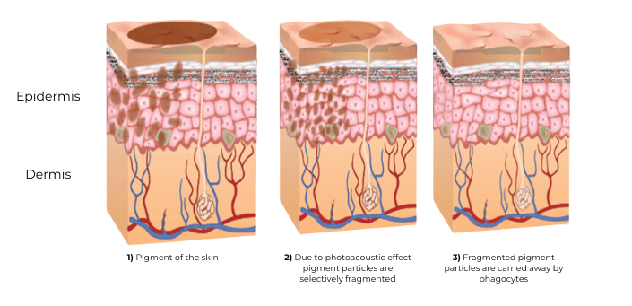 NuWave YAG Mini Pigmentation