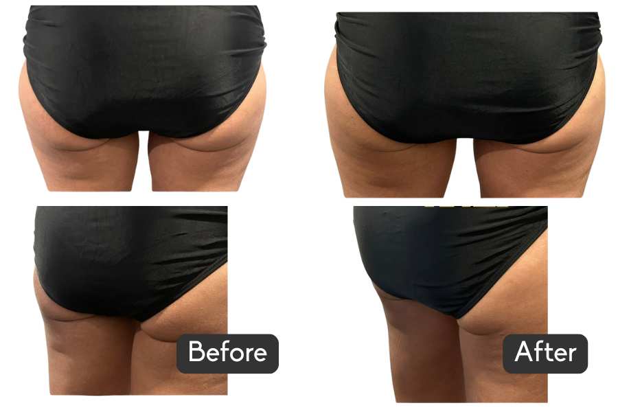 nuFORM Before & After