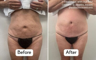 The Physics and Biology of RF Fascia Remodeling for Complete Body Transformation