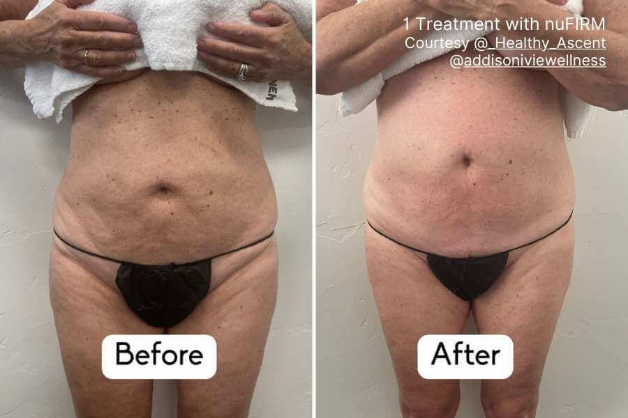 nuFIRM Before & After