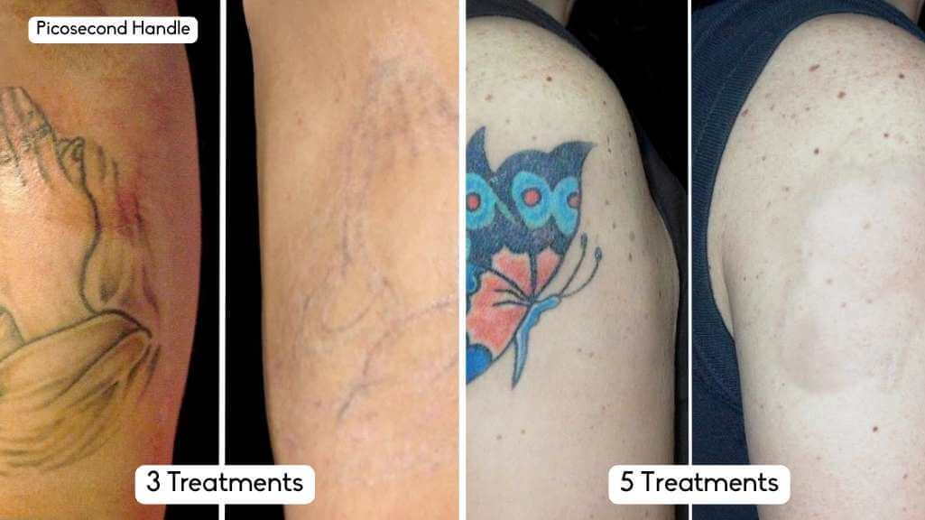 nuCORE Before & After