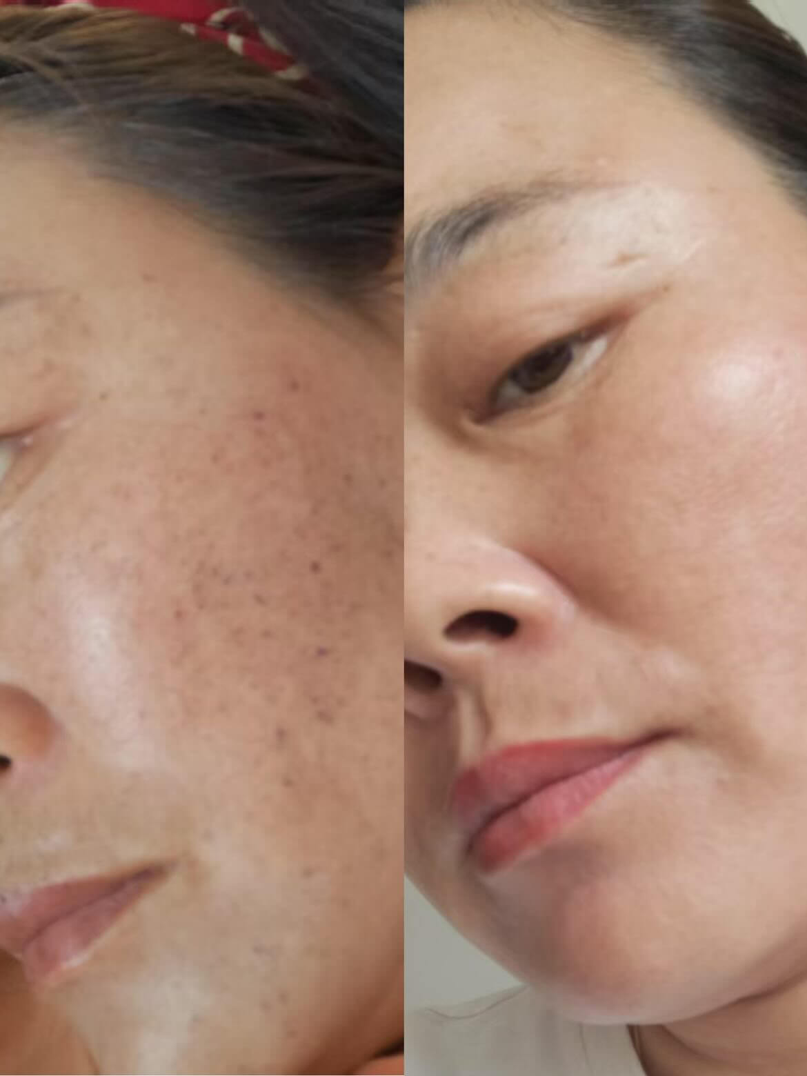 nuCORE IPL Before & After